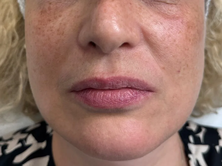 Filler labbra: prima del trattamento, caso 8