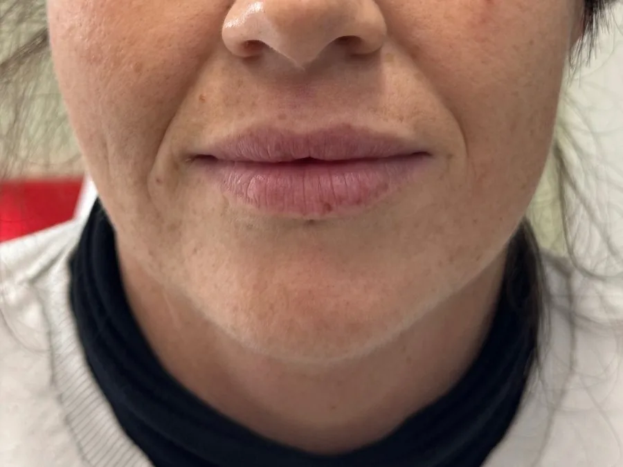 Filler labbra: prima del trattamento, caso 7