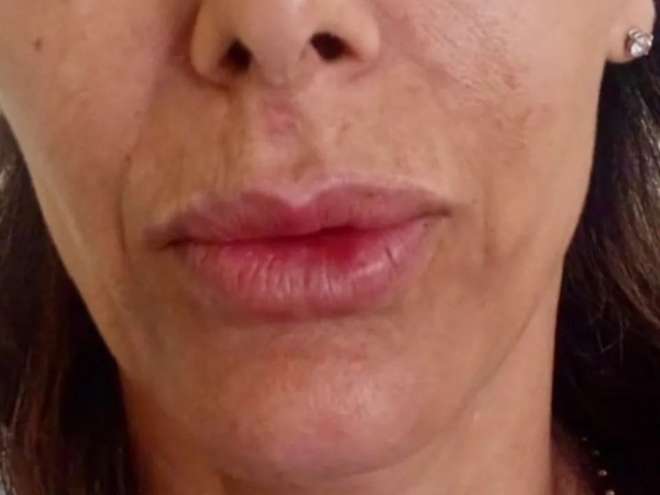 Filler labbra: dopo il trattamento, caso 2