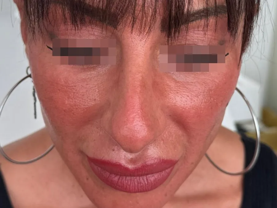 Filler zigomi: prima del trattamento, caso 2