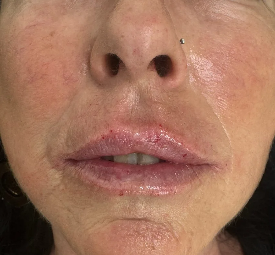 Filler labbra: dopo il trattamento, caso 6