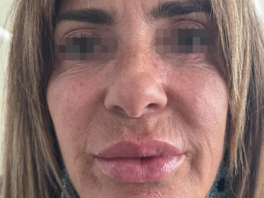 Filler zigomi: dopo il trattamento, caso 1