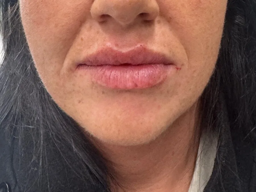 Filler labbra: dopo il trattamento, caso 7