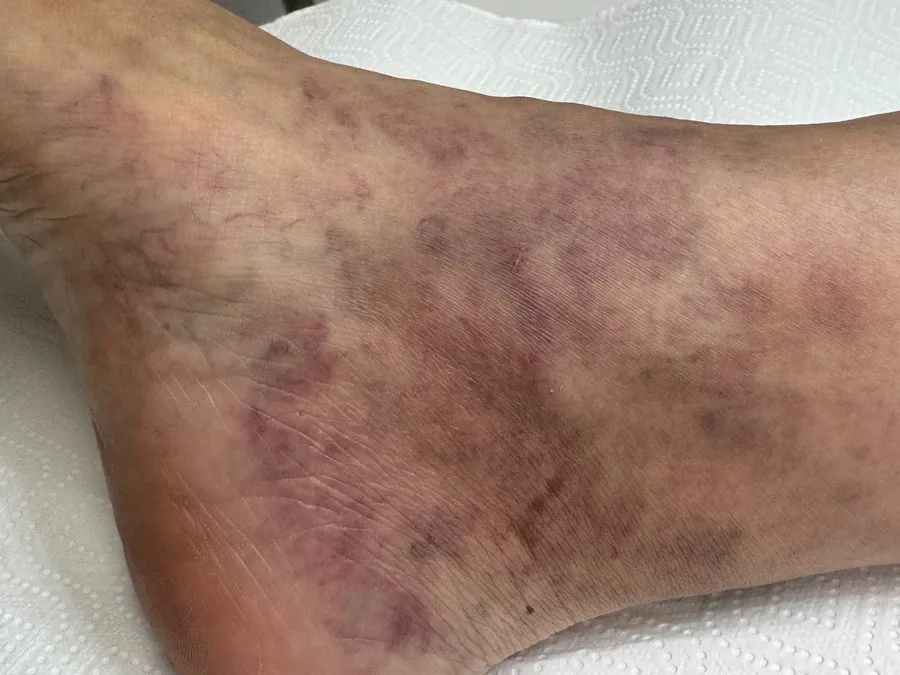 Scleroterapia dei capillari: prima del trattamento, caso 1