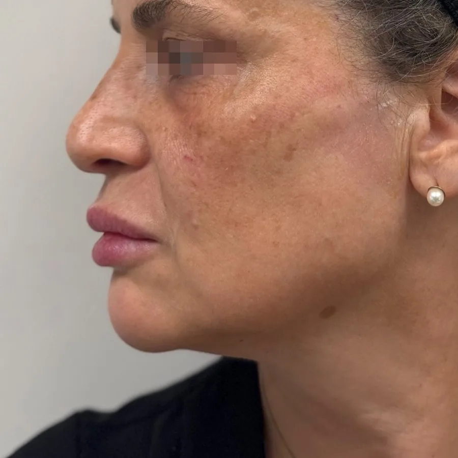 Filler mento e profiloplastica mandibolare: dopo il trattamento, caso 4